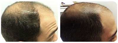 Hair Restoration 